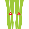 ACL injury example